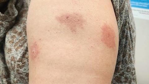 Close up of a patient's arm with a blotchy rash