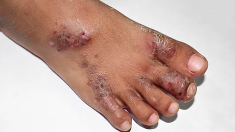 Scabies infection on a foot