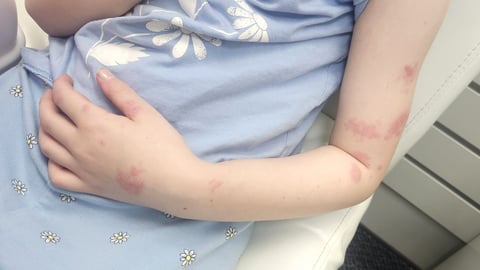 Little girl with a rash on her arm