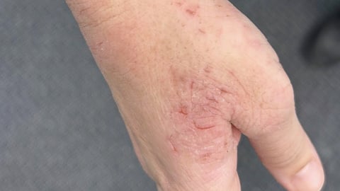 Dry, cracking, excoriated patches on the back of a patient's hand. 
