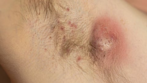hidradenitis suppurativa under a patient's armpit