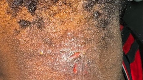 A dark-skinned young man with a rash on his neck