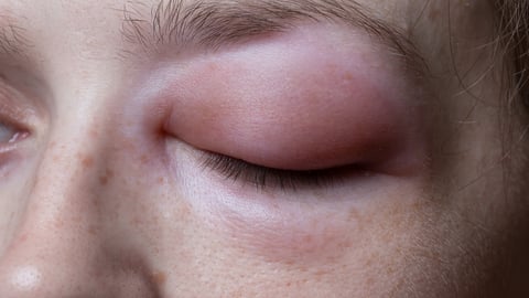 A woman's eye swelling dramatically