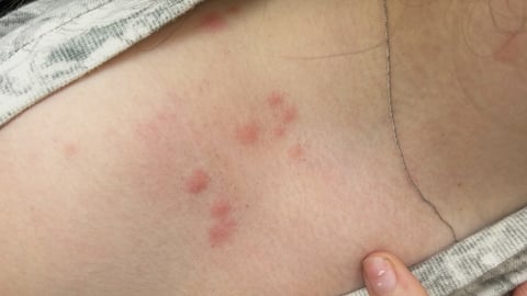 Close up of bug bites of the upper part of a fair-skinned patient's chest