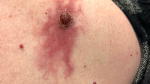 A very irritated mole