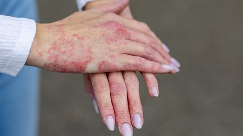 Young fair-skinned with woman with pained nails with her hands covered in painful-looking psoriasis