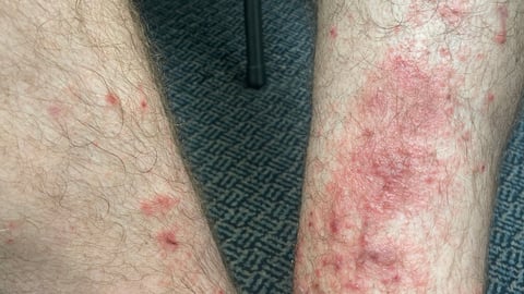 Fair-skinned patient's leg with a bumpy rash