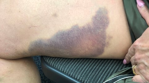 Large bruise on a patient's thigh