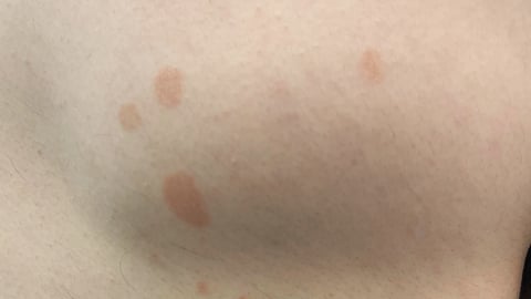 Close up of a small rash