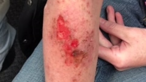 A large scratch of a fair-skinned patient's arm