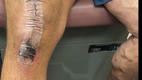 Picture of brown-skinned patient's leg with stitches on the knee