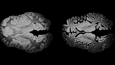 Scan of a brain