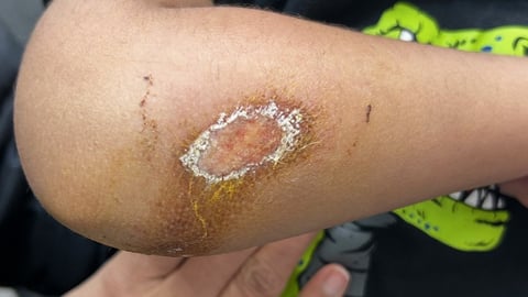 Close up of a patient's arm with a nasty welt 