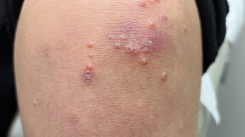 Patient's knee with a skin rash