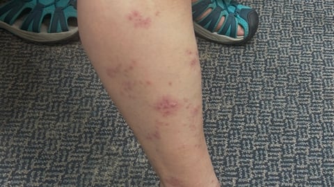 Patient's leg with lesions on it