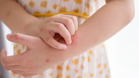 Close up of young fair-skinned girl with a rash on her arm