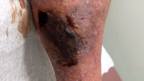 A patient's leg with a severe bruise