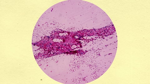Germ cell tumours
