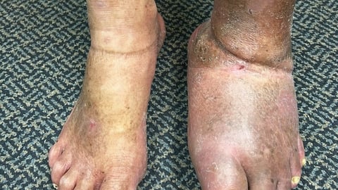 A patient's feet with one very swollen for complications of diabetes
