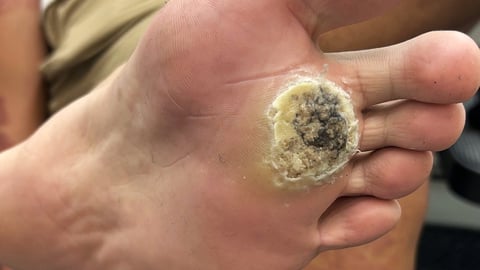 Close up of patient's foot with unusual infected blister on the bottom