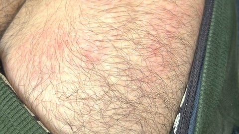 A rash on a fair-skinned patient's skin