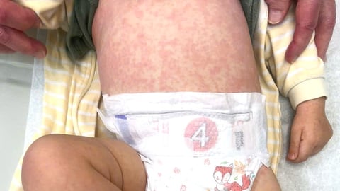 A baby wish a full body rash