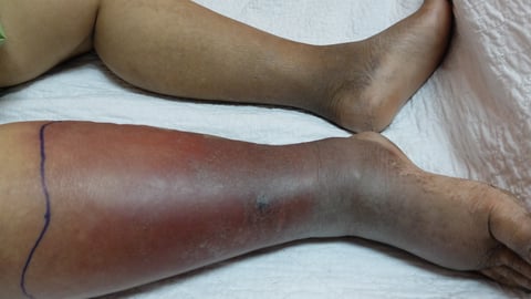 Two legs, dark skin, one leg red with cellulitis