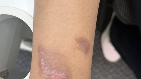 A close up of a patient's arm with an odd rash