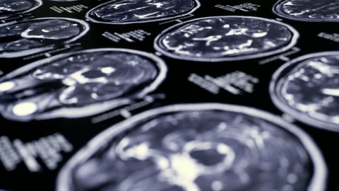 Close up of the results of an MRI brain scan 