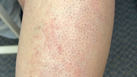 Close up of a patient's leg with a rash 