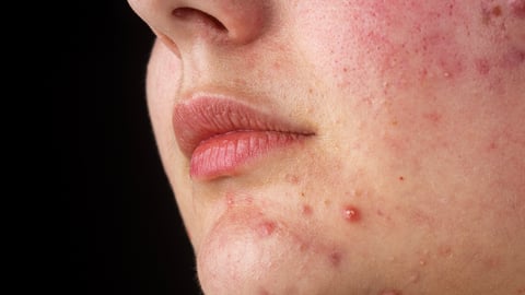 A young white woman's chin covered in acne