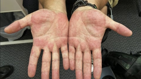 A patient's palms with a red rash