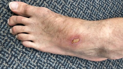 A patient's foot with a wound
