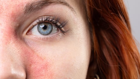 A young white woman with red patchy near her nose