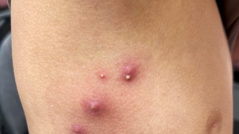 A close up of a patient's arm with an acne-like rash