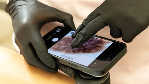 A healthcare provider examines a skin lesion with a digital dermoscopy device.
