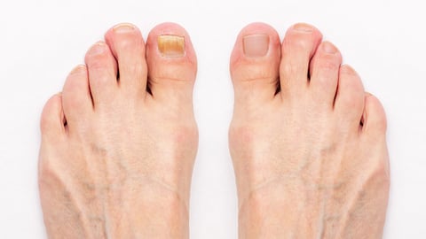 Close up of a pair of feet with a fungal infection on one toe