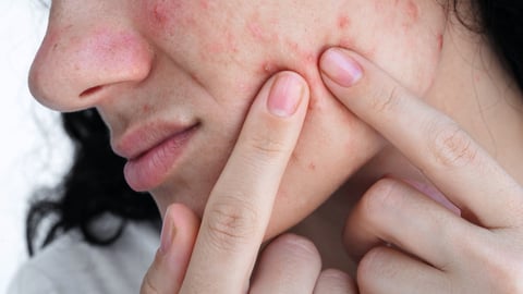 A young woman presses acne and pimples on skin on face with her fingers.