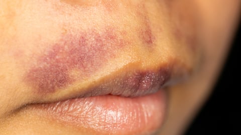 a young person's lips with wounds caused by Systemic Lupus erythematosus (SLE) or Lupus.