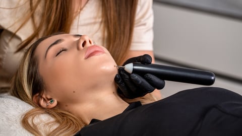 A clinician applies a laser treatment onto a mole.