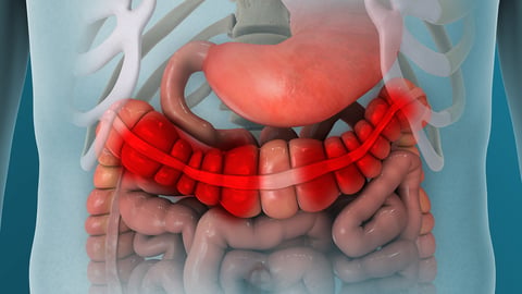 Cartoon rendering of inflamed large intestines