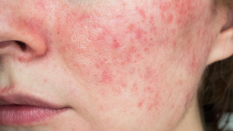 papulopustular rosacea, close-up of the patient's cheek; Shutterstock ID 1812893338