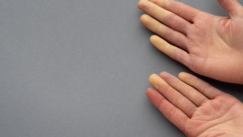 Raynaud's disease (syndrome). Hands of a young woman suffering from raynaud's phenomenon. Female fingers turning white and red due to cold or stress. Rheumatology