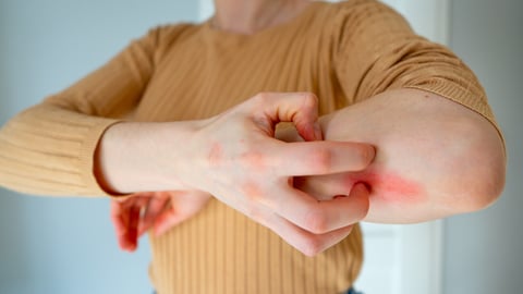 Young woman scratches the itching on her hands with a reddening rash. Itching is caused by dermatitis (eczema), dry skin, burns, food, drug allergies, insect bites. Health care concept.; Shutterstock ID 1947800311