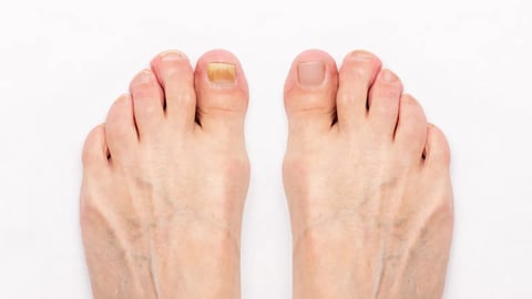 Close-up of a male foot with yellow ugly fungus on toenails and healed nails before and after treatmet isolated on a white background. Fungal nail infection.