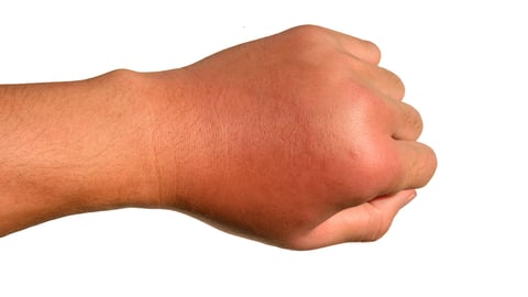 a hand clenched in a fist with swelling at the knuckles from an  infected insect bite