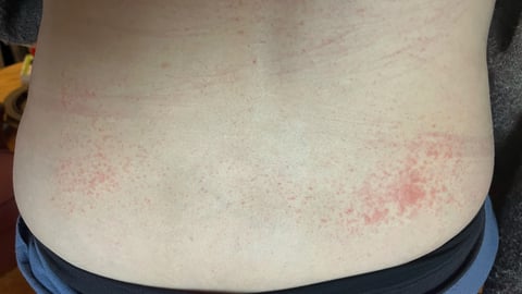 woman's back with rash