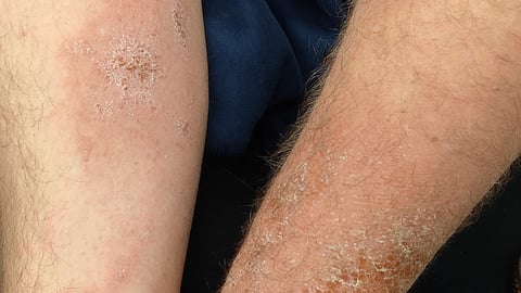 Poison ivy rash on arms