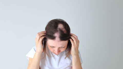 Young white woman with chunks of hair falling out due to alopecia