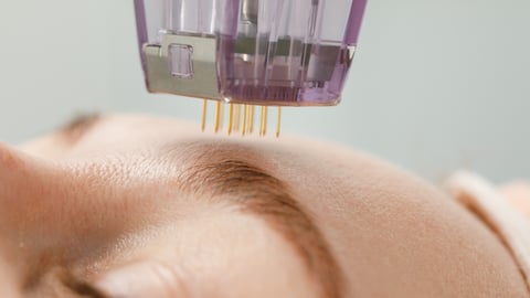 Microneedle mesotherapy. Woman receiving micro needling rejuvenation treatment in a cosmetology clinic.